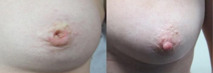 Inverted nipples girl, very short bikini woldrecord
