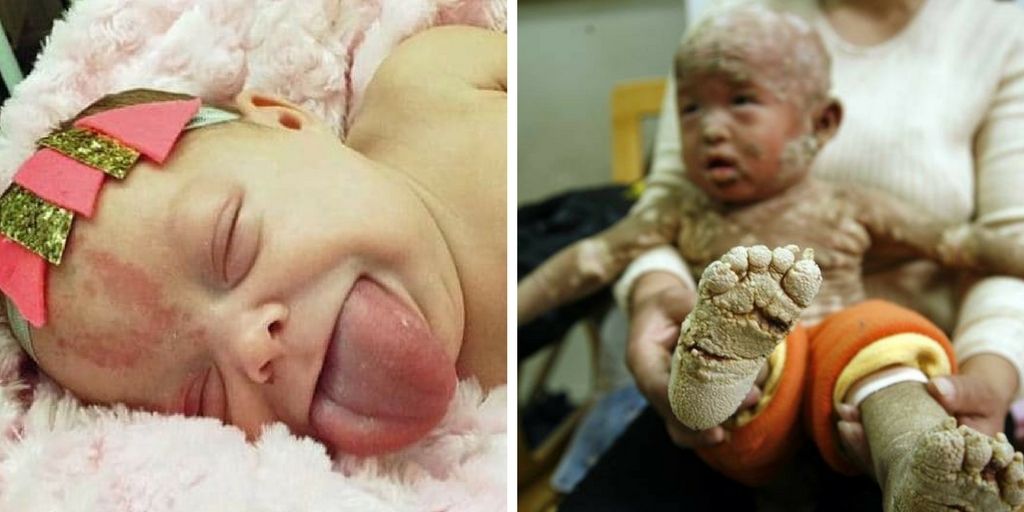 16 Kids Born With The Rarest Birth Defects | BabyGaga